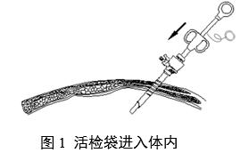 一次性使用内窥镜用活检袋注册审查指导原则(2025年第20号)(图1) 一次性使用内窥镜用活检袋注册审查指导原则(2025年第20号)(图1)