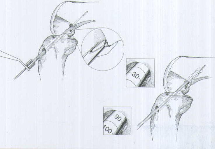 肌腱韧带固定系统注册技术审查指导原则（2020年第36号）(图1)